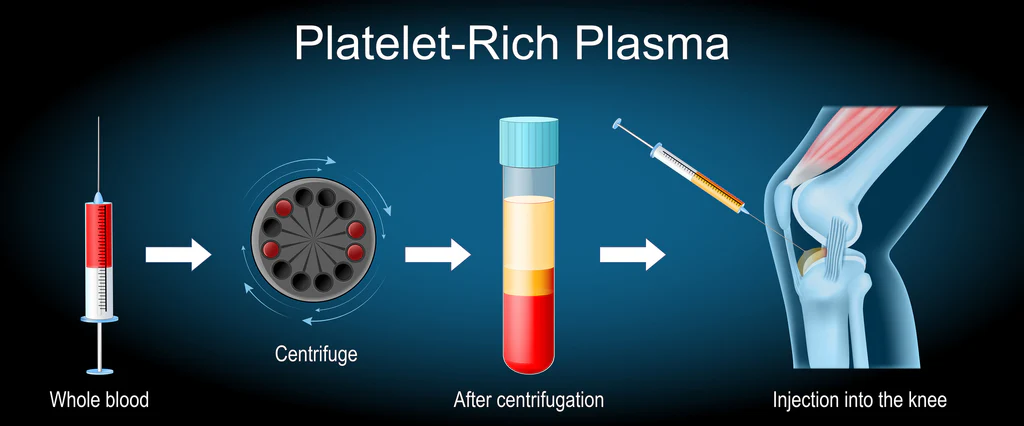 PRP Platelet-Rich Plasma Fairhope Alabama