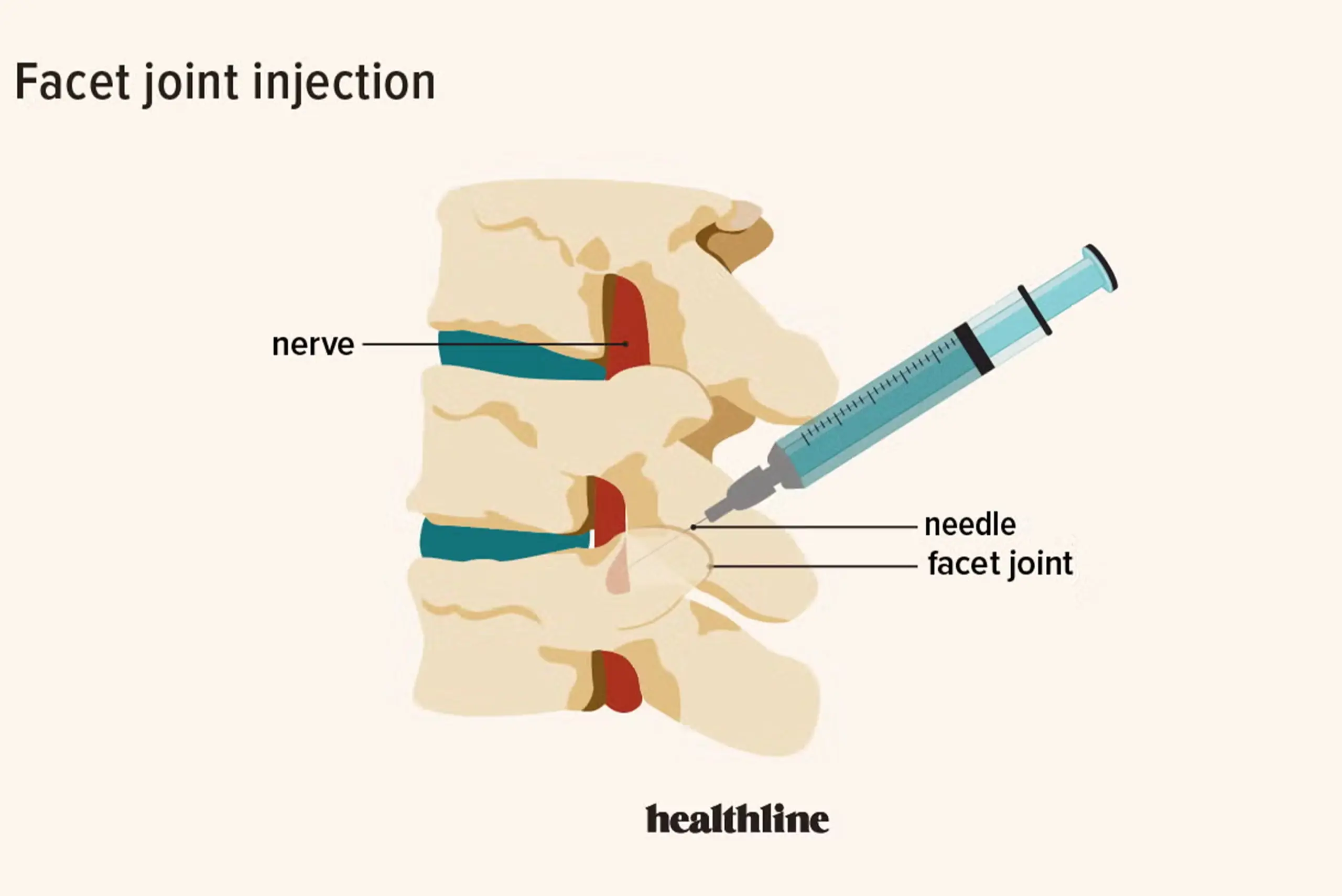 facet joint injection Fairhope Alabama